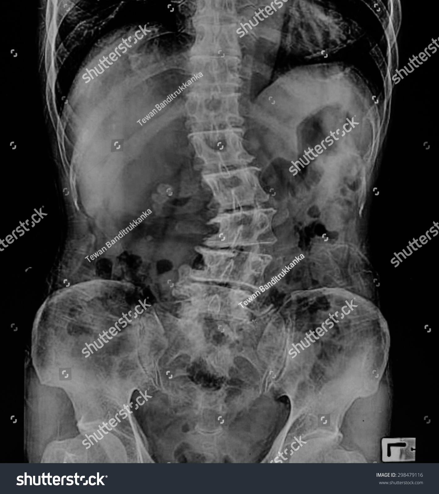 脊柱侧弯膜X射线腰椎间盘:老年患者脊柱弯曲-