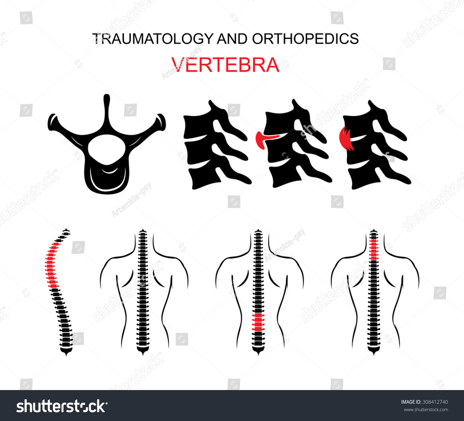 插图的脊椎,颈椎,脊椎疝、扭伤、脊柱侧凸。背
