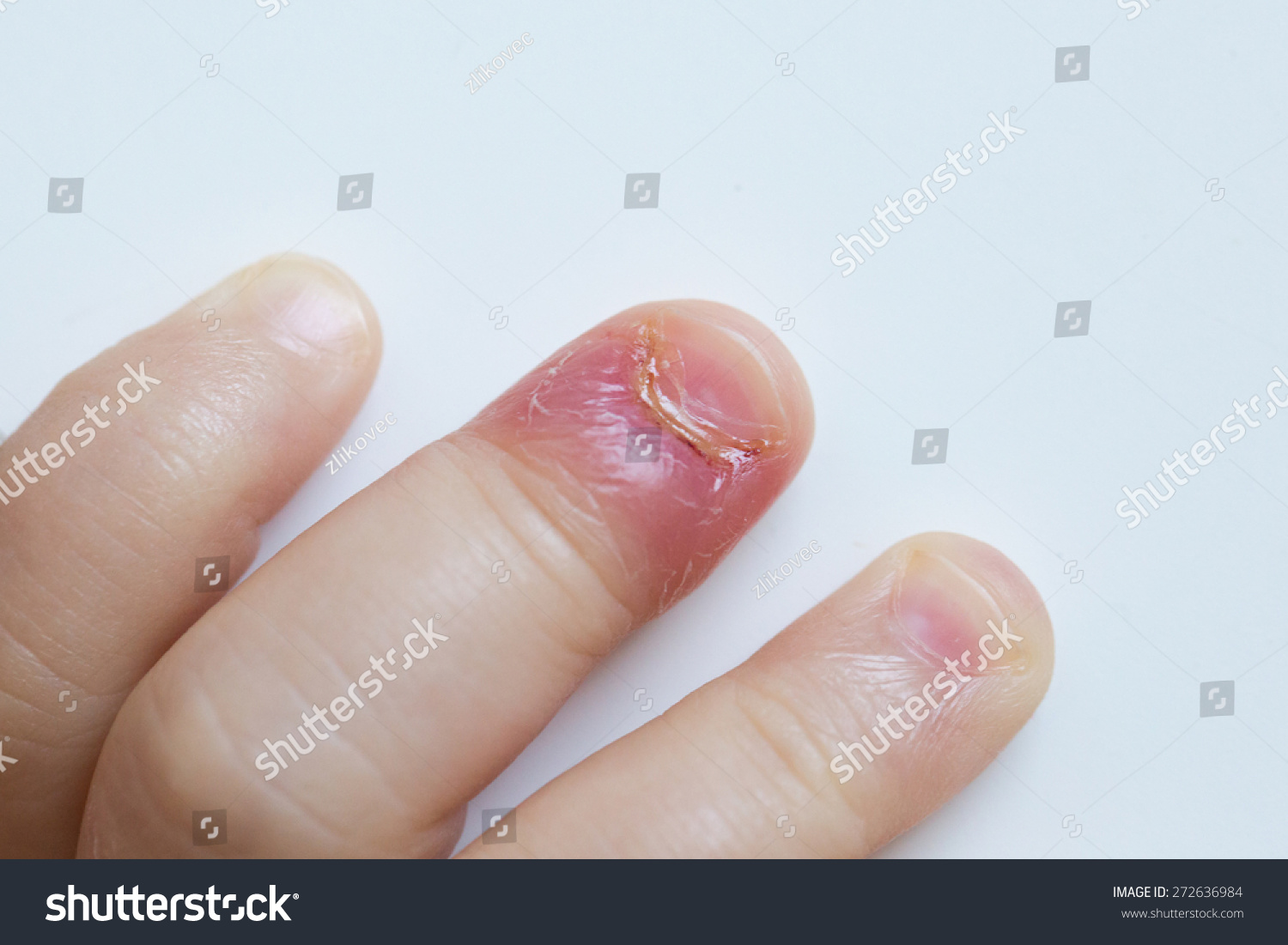 细菌感染手指图片